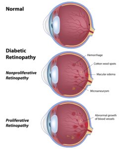 Diabetic Retinopathy diagram 