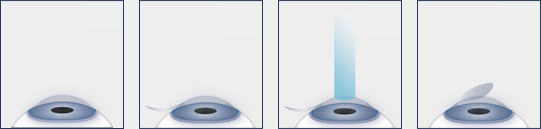 LASIK Eye Surgery Diagram