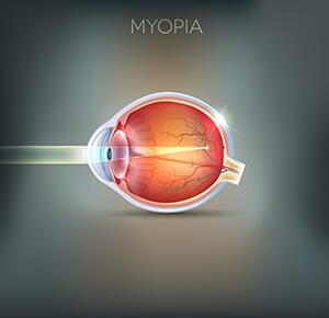 Myopia Diagram