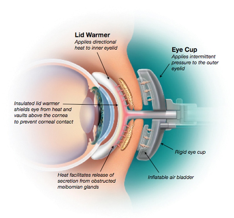 dry eye LipiFlow Cross Section diagram