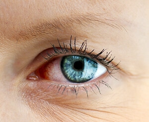 Close-up of an eye affected by Dry Eyes 