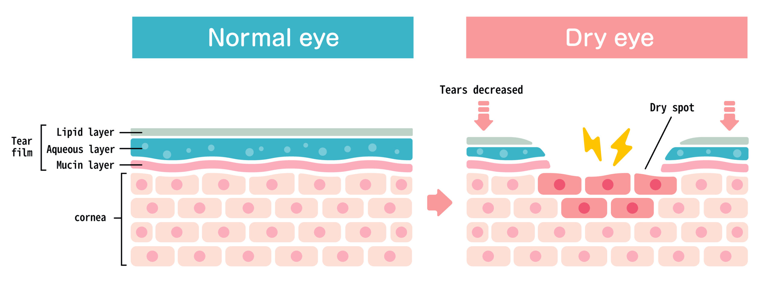 Comparison illustration between normal and dry eye. Cross section of eye surface.