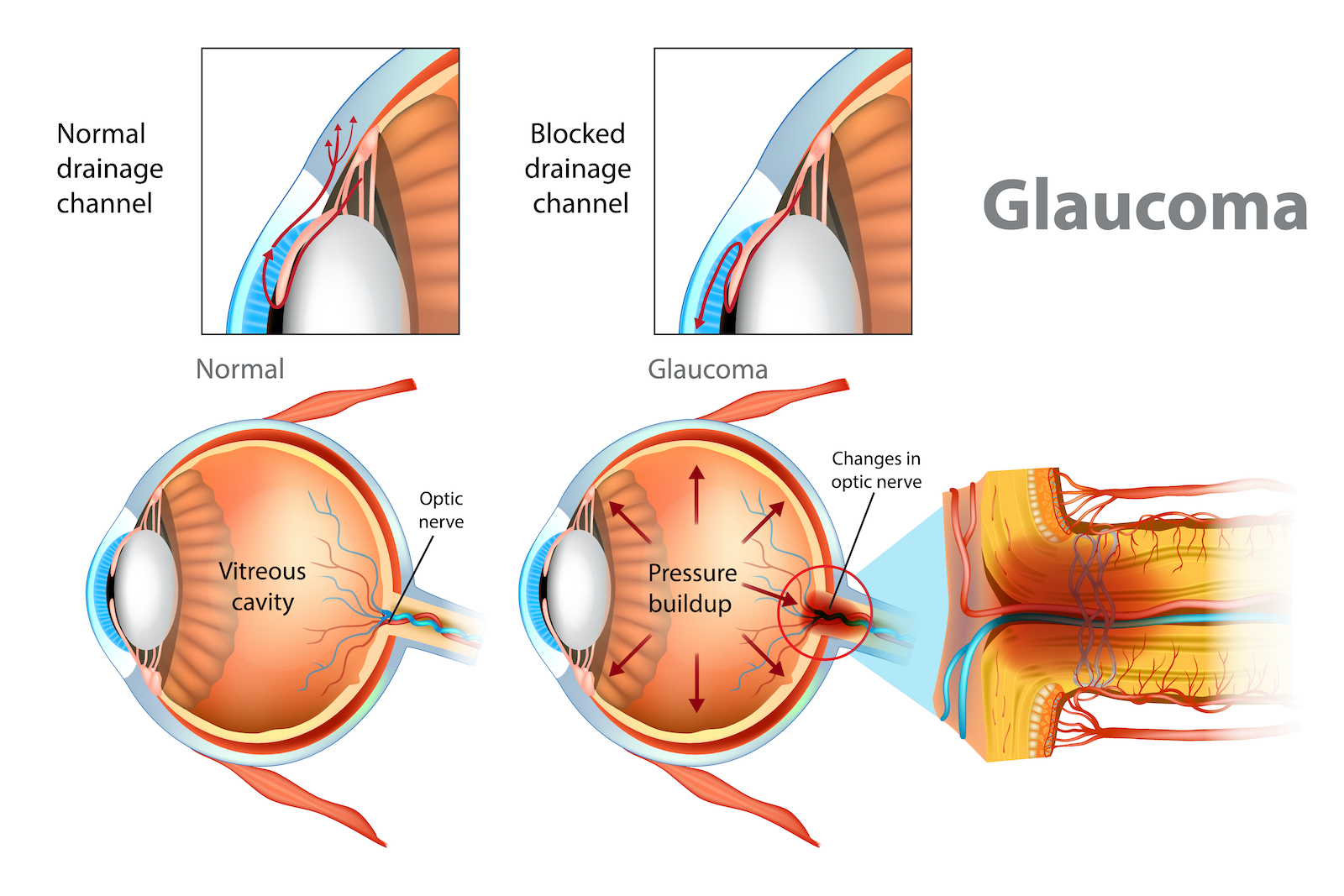 Glaucoma. Illustration showing open-angle glaucoma. Intraocular pressure in the back of the eye