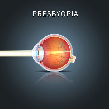 Diagram of light hitting an eye with Presbyopia